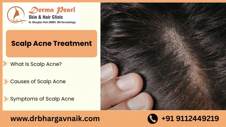 scalp acne treatment​