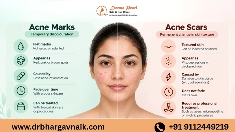 Acne Marks vs Acne Scars